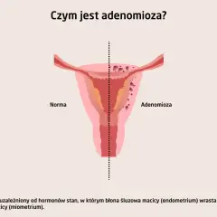 Ilustracja porównuje zdrową macicę (Norma) z macicą dotkniętą **adenomiozą**, gdzie tkanka endometrium wrasta w mięśniówkę.