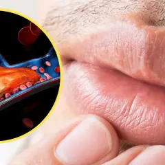 Objawy wysokiego cholesterolu, które mogą zaskoczyć każdego z nas