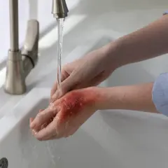 Ręka z oparzeniem jest płukana pod bieżącą wodą. Po takim urazie warto zastosować maść, np. **Argosulfan**, by przyspieszyć gojenie.