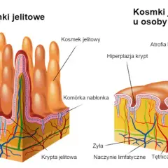 Zanik kosmków jelitowych: 5 faktów o których musisz wiedzieć