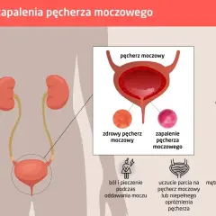 Wirusowe zapalenie pęcherza: Jak rozpoznać 7 kluczowych objawów?