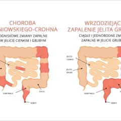 Choroby autoimmunologiczne jelit: 5 głównych przyczyn i terapii
