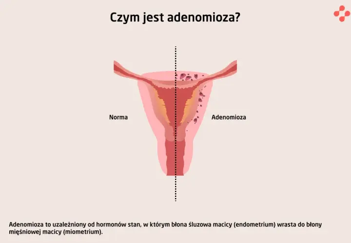 Ilustracja porównuje zdrową macicę (Norma) z macicą dotkniętą **adenomiozą**, gdzie tkanka endometrium wrasta w mięśniówkę.