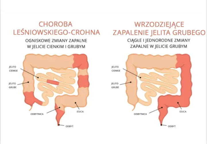 Choroby autoimmunologiczne jelit: 5 głównych przyczyn i terapii