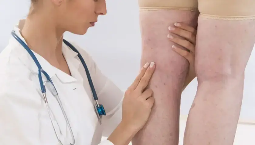 Lekarz bada nogi pacjentki, oceniając potencjalny stan zapalny i jego związek z d-dimerami.