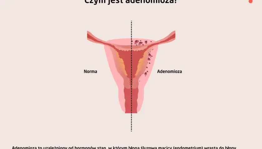Ilustracja porównuje zdrową macicę (Norma) z macicą dotkniętą **adenomiozą**, gdzie tkanka endometrium wrasta w mięśniówkę.