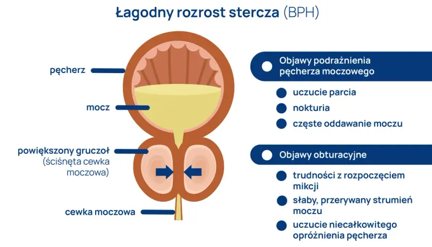 Ilustracja przedstawia łagodny rozrost prostaty (BPH), powiększony gruczoł uciskający cewkę moczową, powodując objawy podrażnienia i obturacji pęcherza.