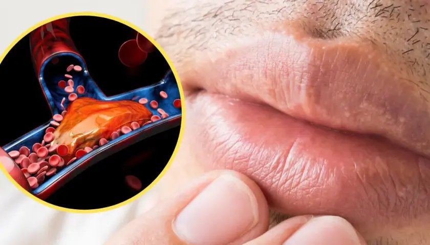 Objawy wysokiego cholesterolu, które mogą zaskoczyć każdego z nas