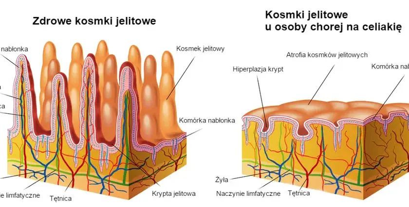 Zanik kosmków jelitowych: 5 faktów o których musisz wiedzieć