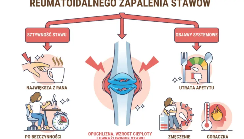 Wczesne objawy rzs: sztywność stawu, opuchlizna, zmęczenie, utrata apetytu i gorączka.
