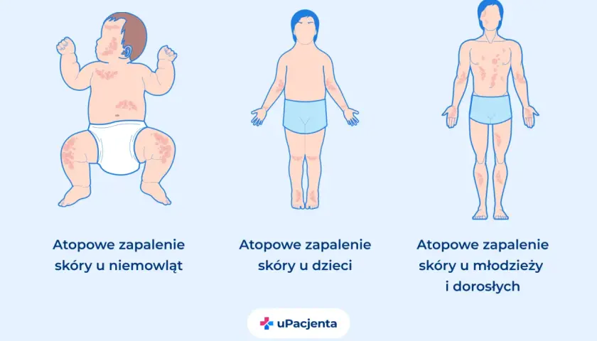 Atopowe zapalenie skóry (AZS) to choroba skóry widoczna u niemowląt, dzieci i dorosłych, objawiająca się zmianami skórnymi.