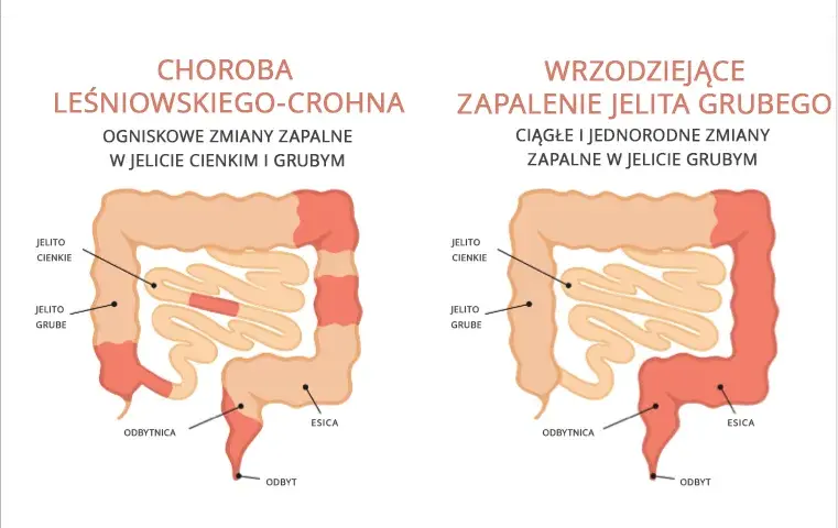 Choroby autoimmunologiczne jelit: 5 głównych przyczyn i terapii