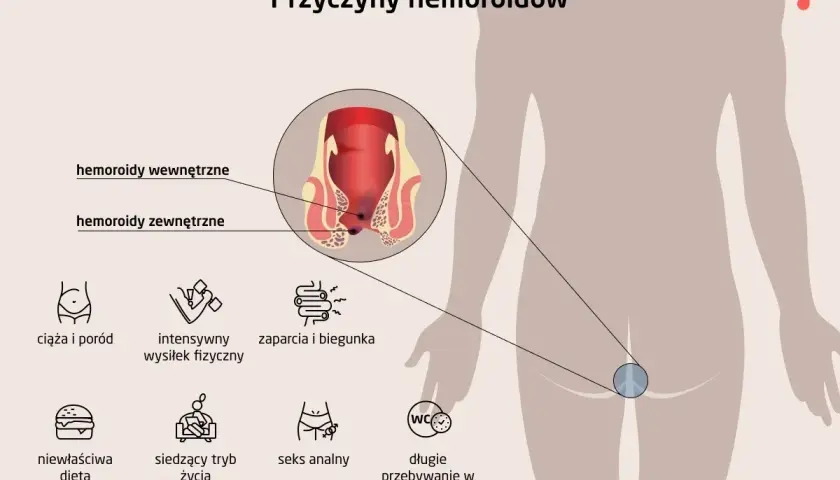Ilustracja przedstawia przyczyny hemoroidów: ciąża, wysiłek fizyczny, zaparcia, dieta, siedzący tryb życia, seks analny, długie przebywanie w toalecie.