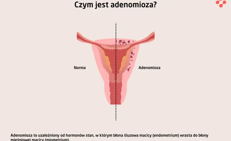 Adenomioza - ból i krwawienia. Czy to nie endometrioza?