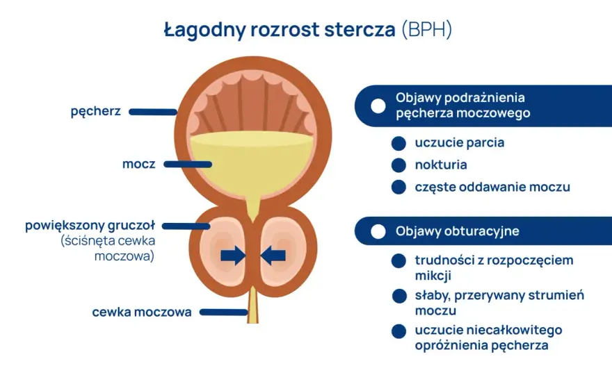 Przerost prostaty - jak rozpoznać objawy i co naprawdę pomaga