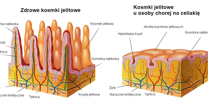 Zanik kosmków jelitowych: 5 faktów o których musisz wiedzieć