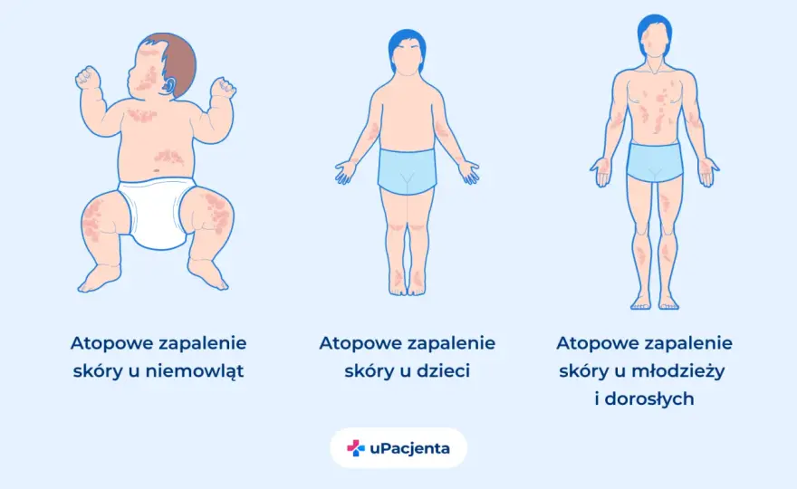 AZS co to? Atopowe zapalenie skóry - objawy, leczenie, pielęgnacja