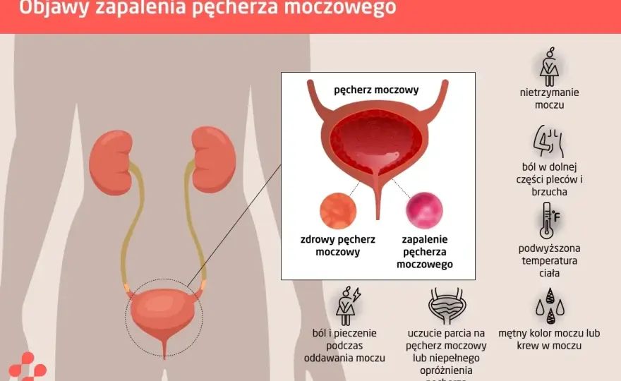 Wirusowe zapalenie pęcherza: Jak rozpoznać 7 kluczowych objawów?