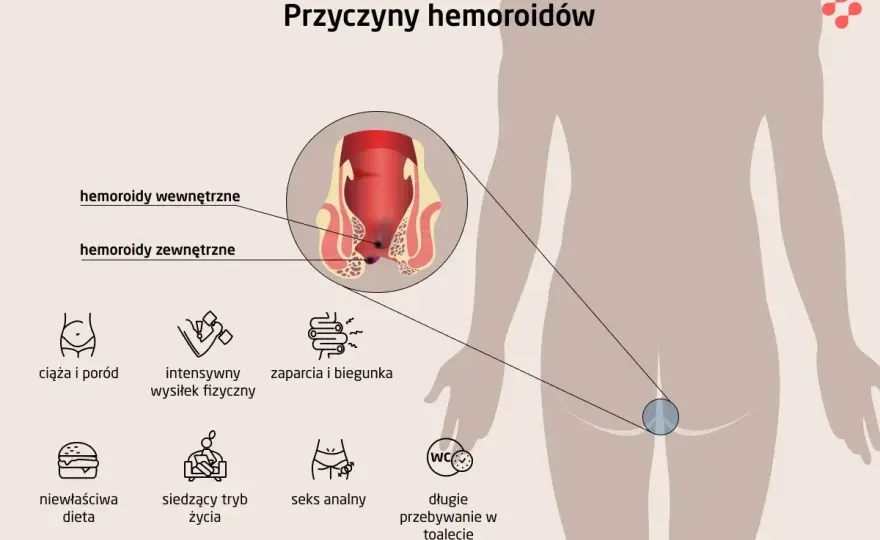 Hemoroidy - Prawdziwe przyczyny i jak im zapobiegać?
