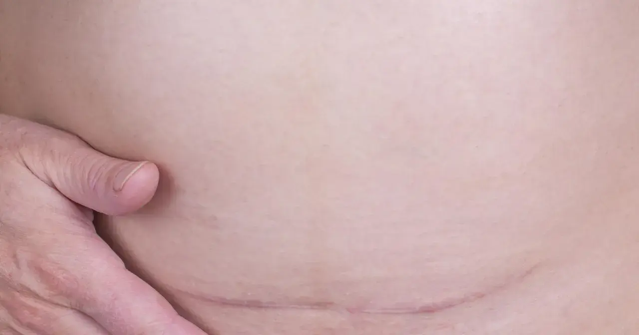Jakie zioła na zrosty pooperacyjne są najskuteczniejsze?