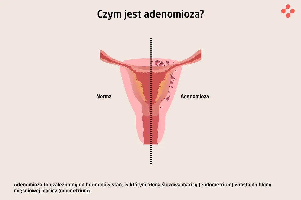 Ilustracja porównuje zdrową macicę (Norma) z macicą dotkniętą **adenomiozą**, gdzie tkanka endometrium wrasta w mięśniówkę.