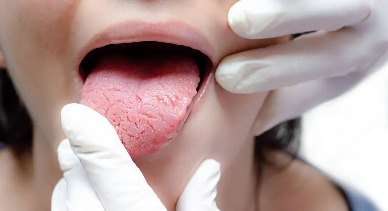 Candida u dzieci: Jakie są objawy i metody skutecznego leczenia?