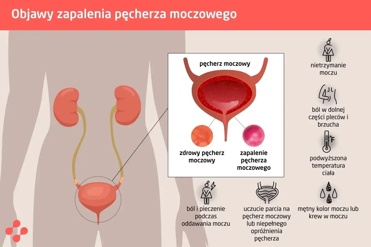 Wirusowe zapalenie pęcherza: Jak rozpoznać 7 kluczowych objawów?
