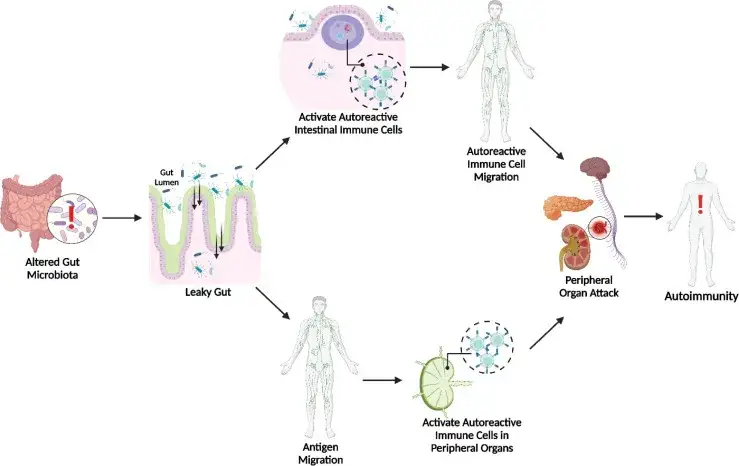Zdjęcie Choroby autoimmunologiczne jelit: 5 głównych przyczyn i terapii