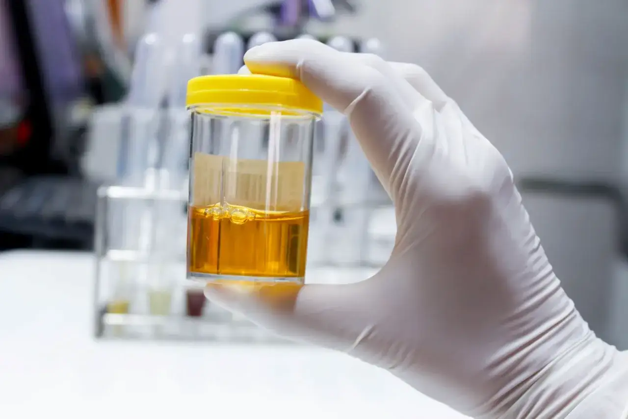 Rękawiczka laboratoryjna trzyma pojemnik z żółtym płynem, potencjalnie badając leukocyty w moczu.